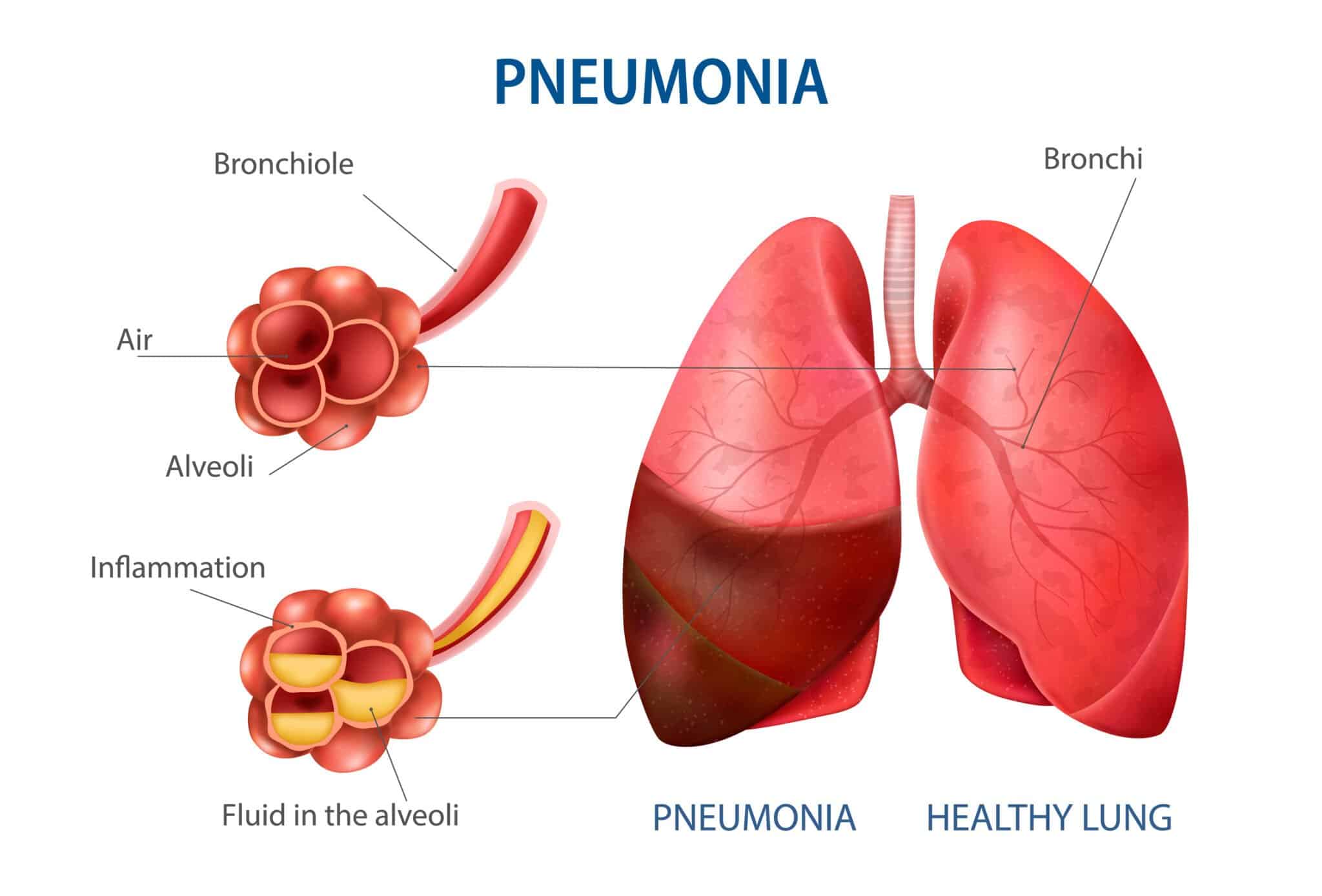 Trelegy Vs. Symbicort; Similarities and Differences - Insulin Outlet